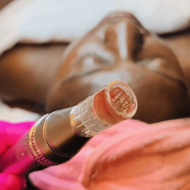 Chemical Peel + Microneedling at The Glo Haus Atlanta in Atlanta, GA