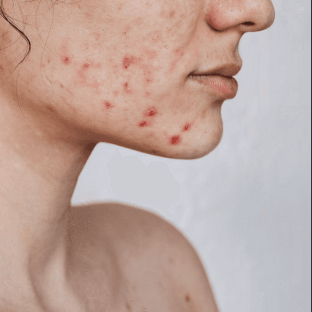 Acne Boot Camp (3 Months) at The Glo Haus Atlanta in Atlanta, GA