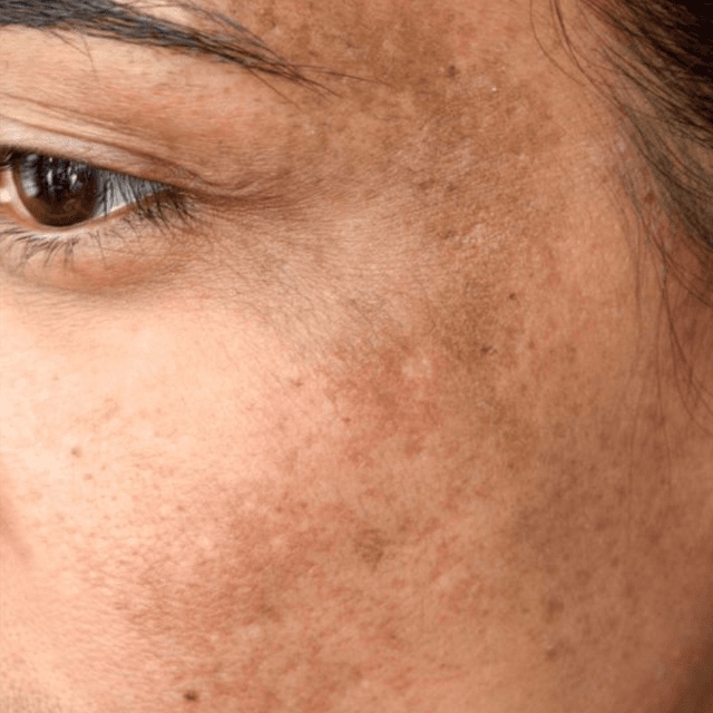 Pigmentation Correction Series at The Glo Haus Atlanta in Atlanta, GA